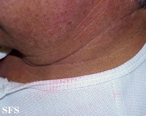 Chromhidrosis - NC Commons