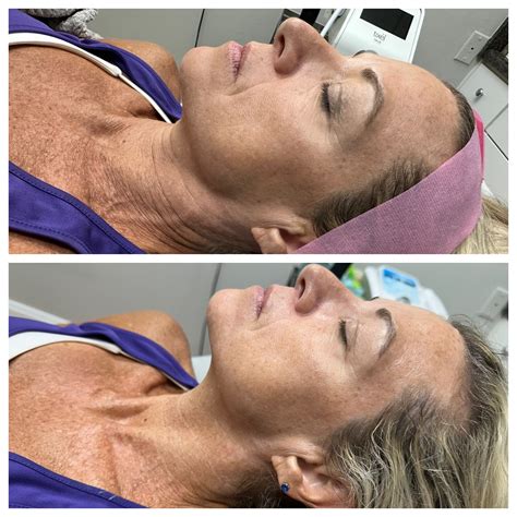 Facials Before & After Portfolio | Marco Island Aesthetics — Marco