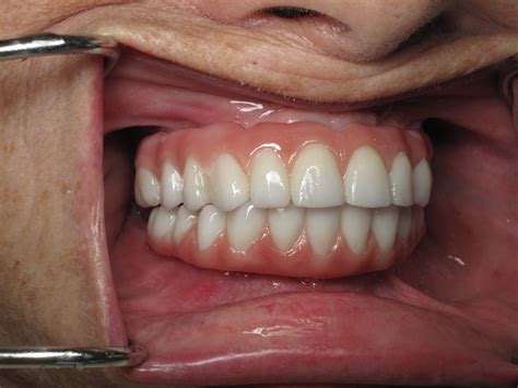 Dental Prosthesis