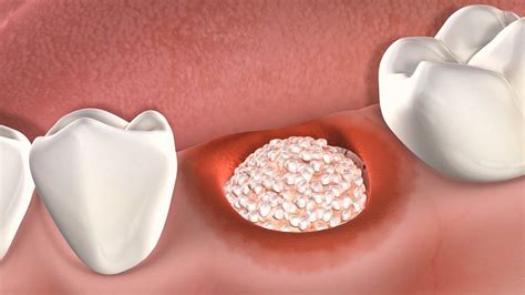 dental bone graft recovery time  andrea cahill blog