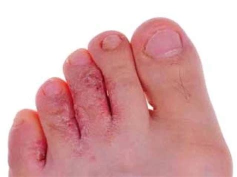 identify athletes foot signs symptoms  solutions husband info