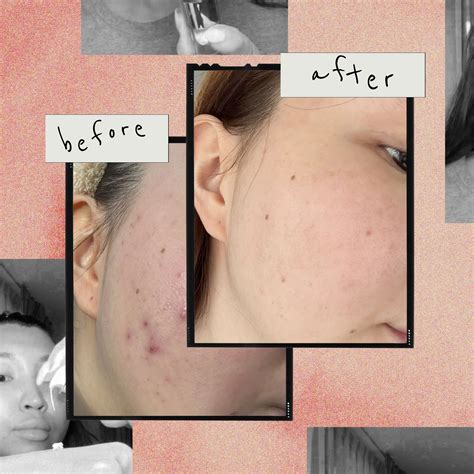What Dermatologists REALLY Think About Unbelievable Blackhead Removal 2024! Image 15