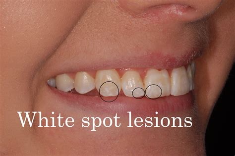 Why Do I Have Brown Spots On My Teeth With Braces - Infoupdate.org