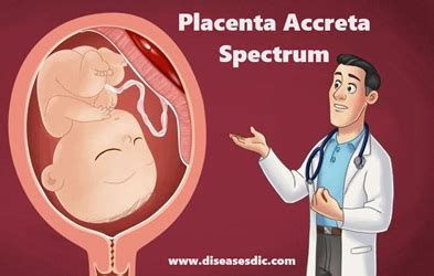 placenta accreta spectrum pas types   treatment