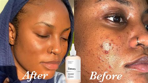 How To Use Glycolic Acid On My Face at Frederick Andre blog