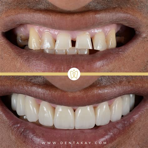 Hollywood's Biggest Secret? Dental Experts Uncover The Truth Behind Tom Cruise's Iconic Smile Image 9