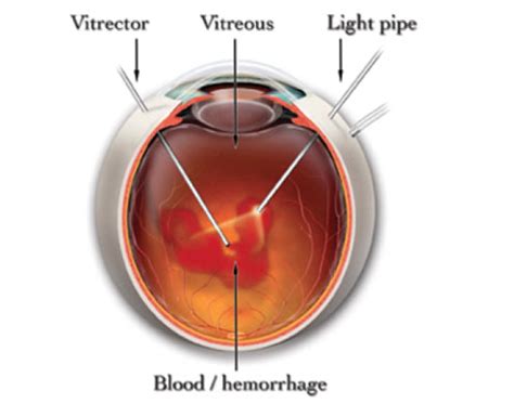 Diabetic Retinopathy | Southern Vitreoretinal Associates