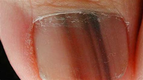 Melanoma On Lips Symptoms | Lipstutorial.org