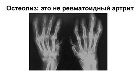 Диагностика и дифференциальная диагностика ревматоидного артрита ...