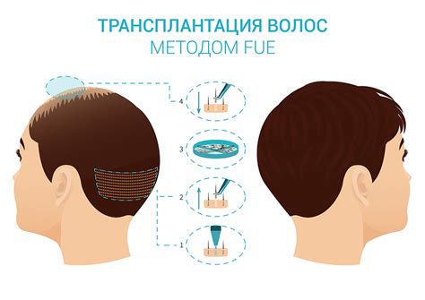 Пересадка волос