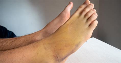 Foot Bruises: Types, Medical Causes, Complications