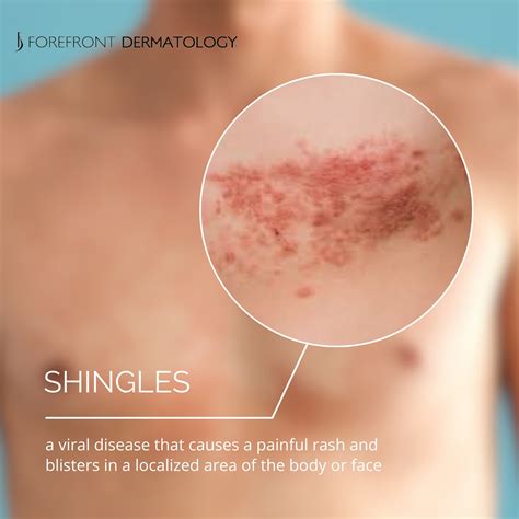 Forefront - Shingles, also known as herpes zoster, is an infection of a