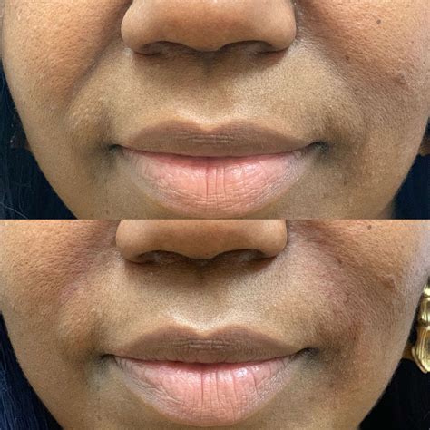 PDO Thread Lift in Newport Beach, CA | Beauty Boost Med Spa
