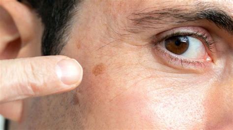 Skin Treatment For Dark Spots On Face at Ramon Flores blog