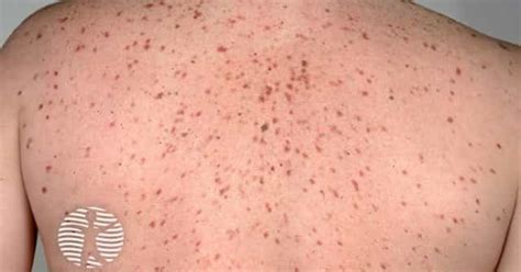 Cutaneous mastocytosis image