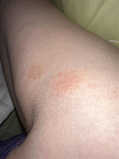 Eczema or ringworm? : r/medical
