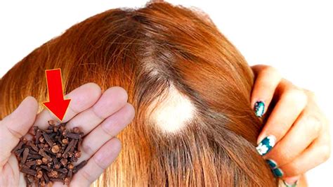 Cravo No Cabelo Antes E Depois - Coloque cravo da índia no cabelo e pare de gastar na farmácia (Sabia ...