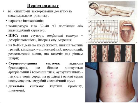 Черевний тиф - презентация онлайн