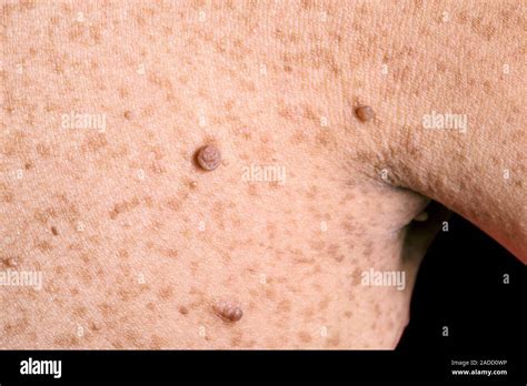 neurofibromatosis neurofibroma growths   skin   armpit