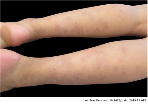 Immunoreactive cutaneous sporotrichosis | Anais Brasileiros de Dermatologia