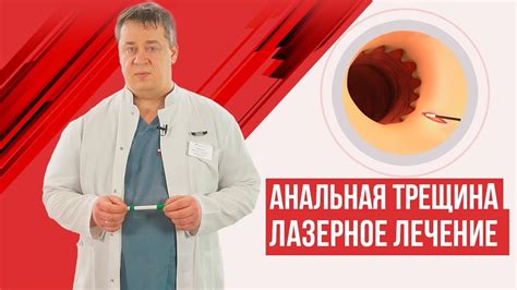 Анальная трещина - лазерное лечение - YouTube