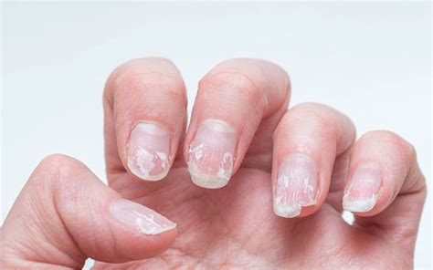 Top 10 Tips to Prevent and Treat Peeling Nails for Stronger Nail Health