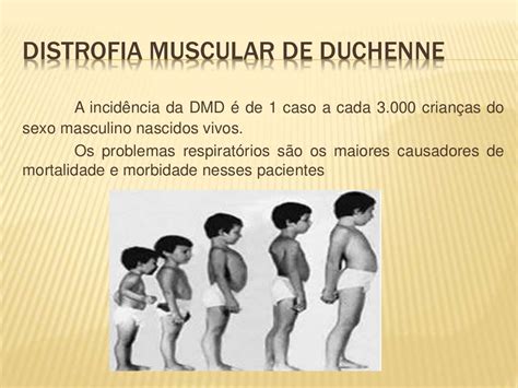 Atrofia Muscular De Duchenne - Distrofia muscular de duchenne