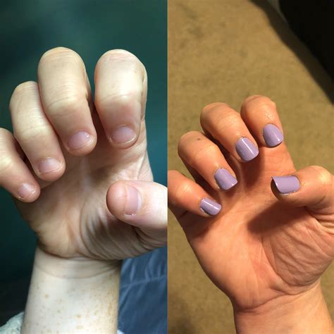 After 23 years I’ve only ever lasted 2 weeks without biting. Today I