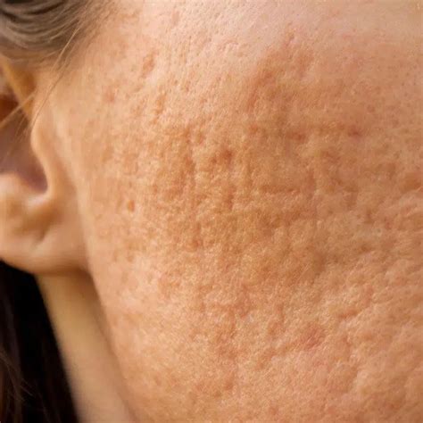 rolling scars acne scars types albany laser