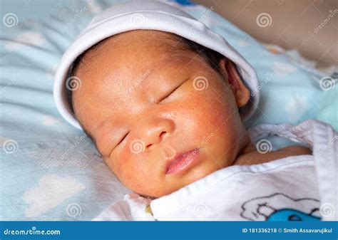 Neonatal Jaundice - Yellowish Discoloration Of The White Part Of The ...
