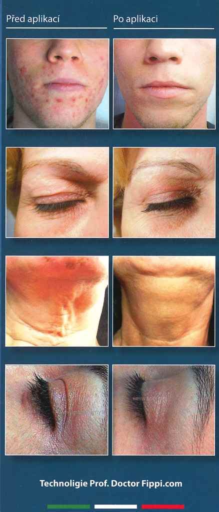 Plexr - plazmový generátor :: ProDerma
