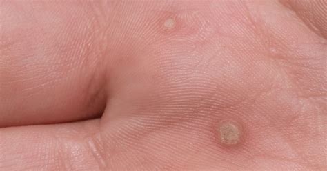 Warzen | Ursache, Behandlung & Tipps | Dr Leenarts
