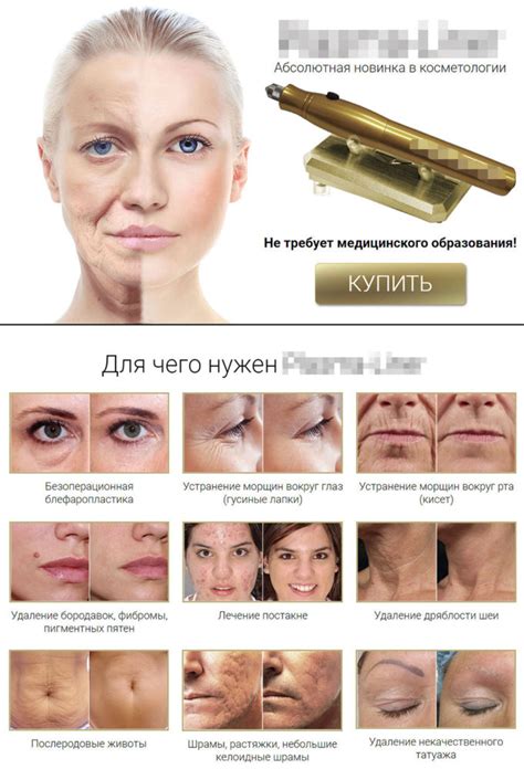 Вопрос: "Как Вы относитесь к процедуре plasma-lift?" Выжигание дырок на ...