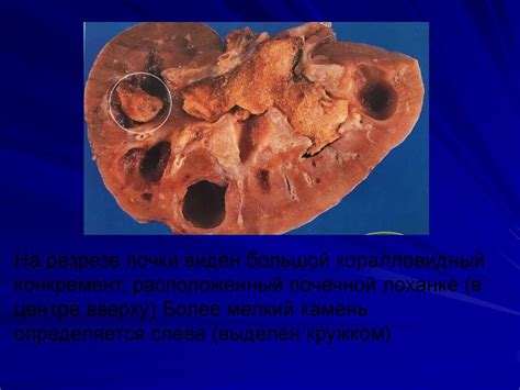 Мочекаменная болезнь - презентация онлайн