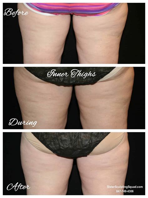 Fat Thighs Before And After