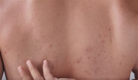 Clear Your Skin: Effective Bacne Trea... – Codex Labs Corp