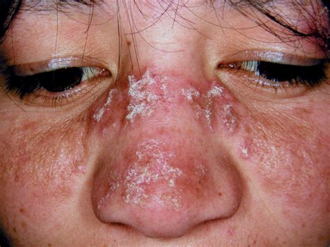 What are the signs and symptoms of lupus?