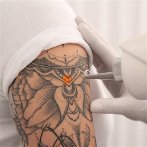 Laser Tattoo Removal | Laser Tattoo Removal near me — DermaEnvy