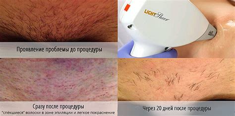 Фотоэпиляция и лазерная эпиляция: сравнение, отличия, разница, что лучше