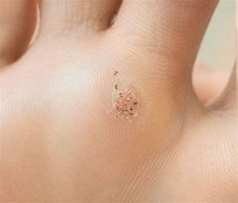 verruca masterclass college  foot health cofh foot health