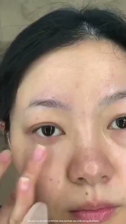 Xử lý bọng mắt, thâm mắt Jomtam - YouTube