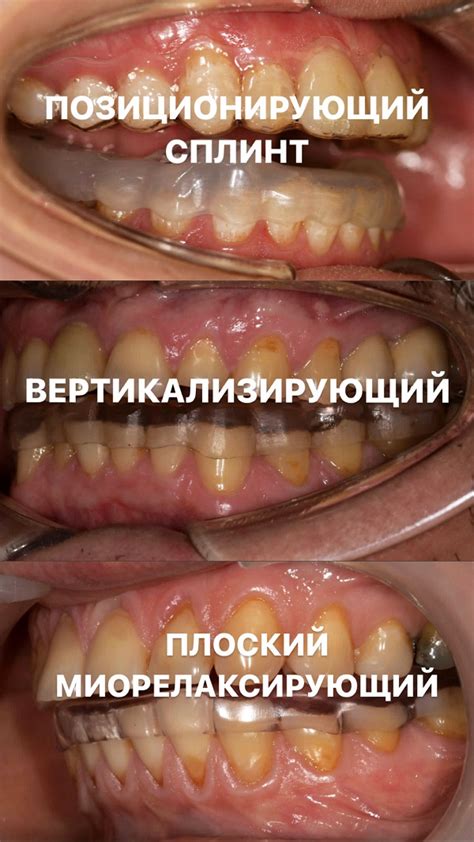 Сплинт - стоматология Орбиталь