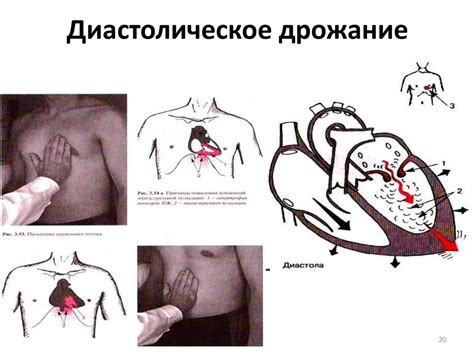 Митральный стеноз (стеноз левого атриовентрикулярного отверстия ...