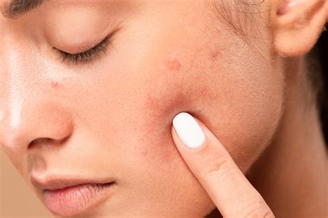 AviClear Laser Acne Treatment | Brisbane Skin