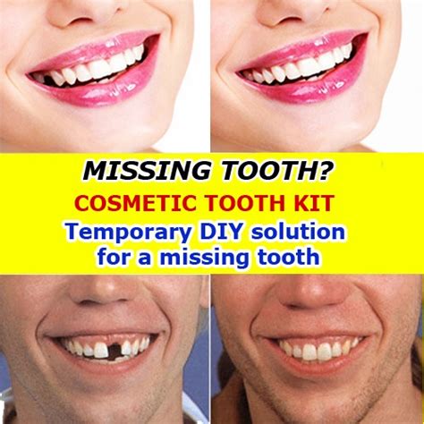 how to cover a missing tooth at home