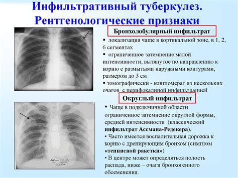 Очаговый, инфильтративный туберкулёз лёгких, туберкулёма, казеозная ...