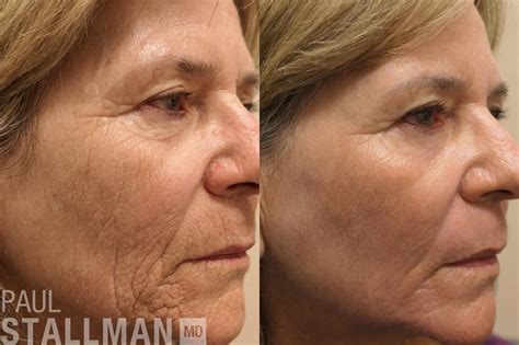 Laser Resurfacing Before and After Pictures Case 186 | Fresno, Santa ...
