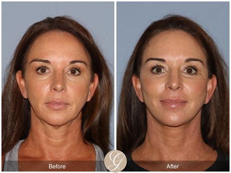 Facelift in Newport Beach, CA | Dr. Kevin Sadati Plastic Surgery