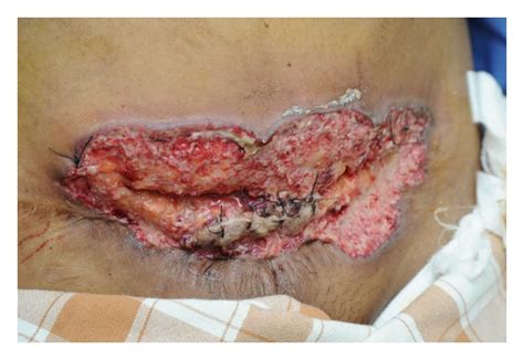 pyoderma gangrenosum   successive pregnancies complicating