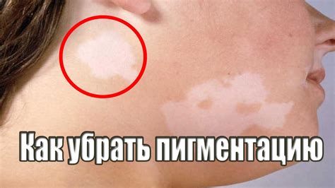 Как отбелить лицо в домашних условиях. ОТБЕЛИВАЮЩИЕ маски для лица ...